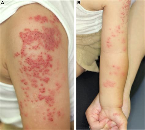 Varicella Vaccine-Induced Infantile Zoster-Like Skin Rash - The Journal of Pediatrics