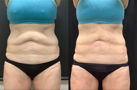 Accufit Before & After Photos Patient 30 | Washington, DC | MI Skin Dermatology Center: Melda ...