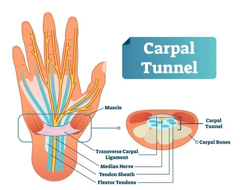Carpal Tunnel Syndrome: What is it? | Lifemark