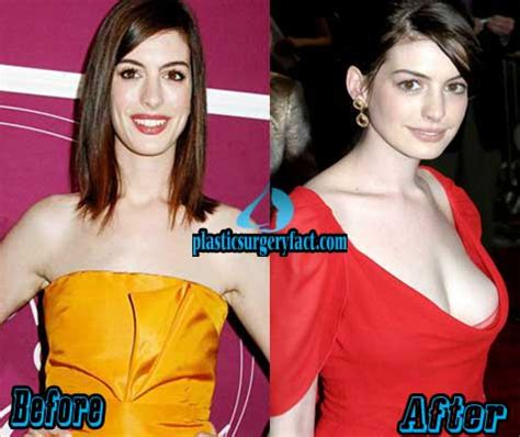 Anne Hathaway Plastic Surgery Before After