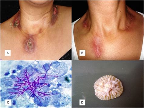 Ganglionar cutaneous nocardiosis in a patient with AIDS - International Journal of Infectious ...