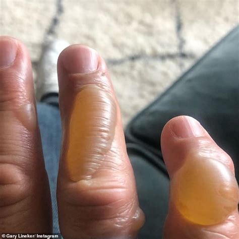 Gary Lineker reveals he burnt his hand while cooking in stomach-churning snap | Daily Mail Online