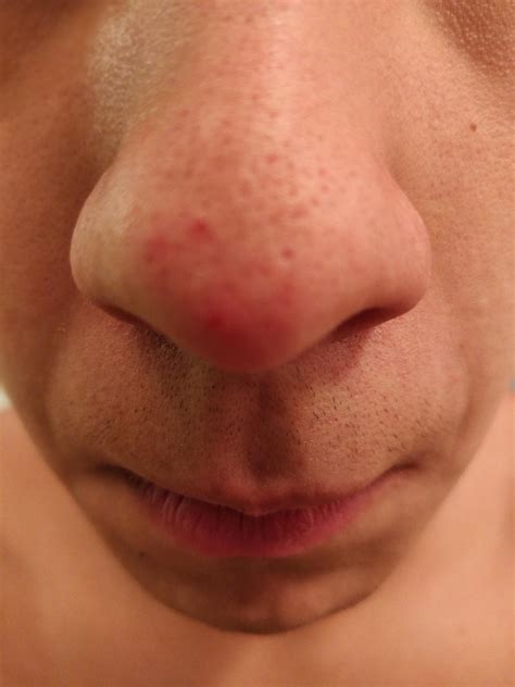 Large Blackheads On Nose