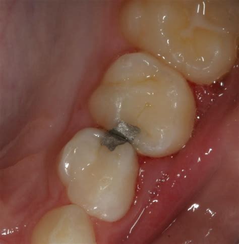 Silver Amalgam Fillings Tacoma WA