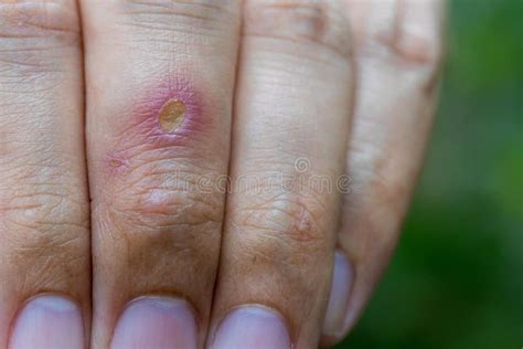 Paronychia, Swollen Finger Inflammation Due To Bacterial Infection on a Man Hand. Wound ...