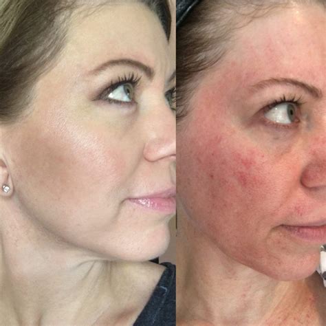 Microdermabrasion vs Dermaplaning vs Microneedling, My Experience and Results ...