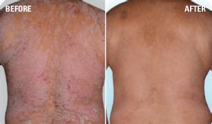 Psoriasis Before & After Pictures | SKYRIZI® (risankizumab‐rzaa)