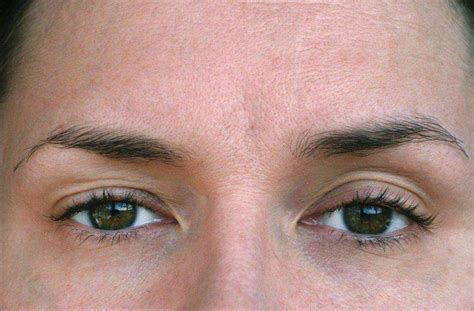Ptosis (Droopy Eyelid) - Symptoms, Causes & Treatment | Lions Eye Institute