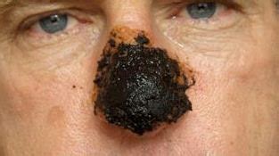 Pictures of skin cancer: skin cancer on nose