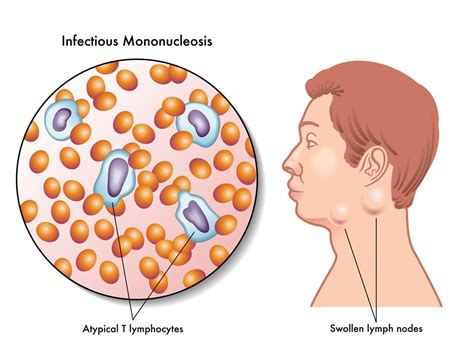 Mono (Infectious Mononucleosis) : Overview, Causes, Symptoms, Treatment - illness.com