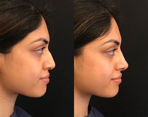 Can We Make Nose Smaller Without Surgery - Infoupdate.org