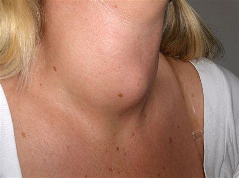 When a Lump in the Neck is Cause for Concern | Lakeshore Ear, Nose & Throat Center