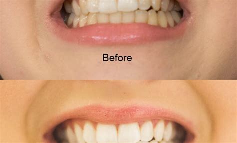 Whitening strips: pros and cons – Healthy Food Near Me