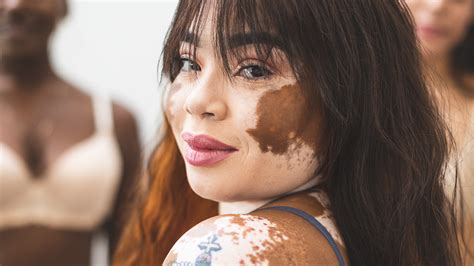 Vitiligo Treatments: Is There a Cure? - GoodRx
