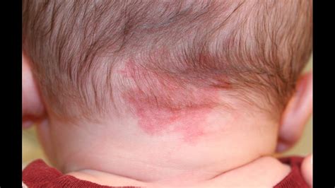 Leucemia Manchas Rojas En La Piel : 14 Enfermedades que causan manchas ...