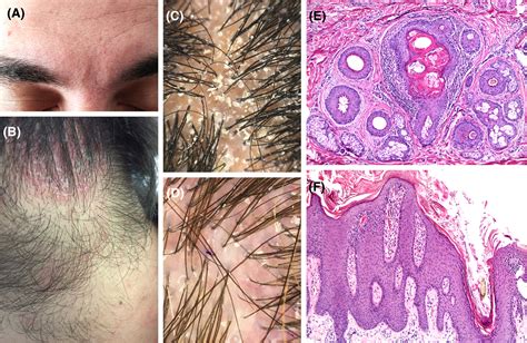 Seborrheic Dermatitis Histology