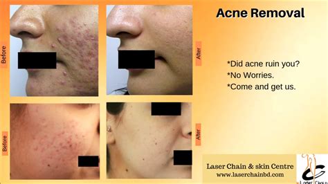 Acne treatment - ব্রনের সমাধান @ Laser Chain and Skin Centre - YouTube