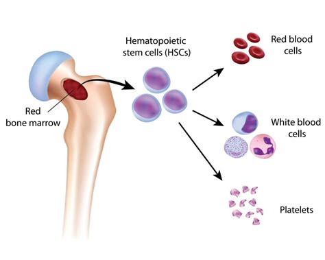 Myelodysplastic Syndrome - Symptoms, Causes, Types, Top 4 Ultimate Risk ...