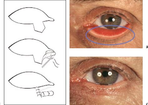 What Is Entropion Surgery