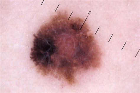 Five-Year OS Nears 40% in BRAF Wild Type Melanoma | MedPage Today