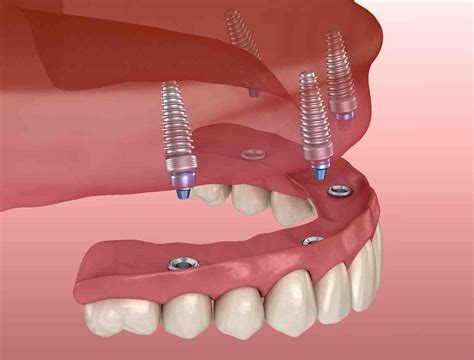 Is there any dental insurance that helps cover mini implants - Dental News Network