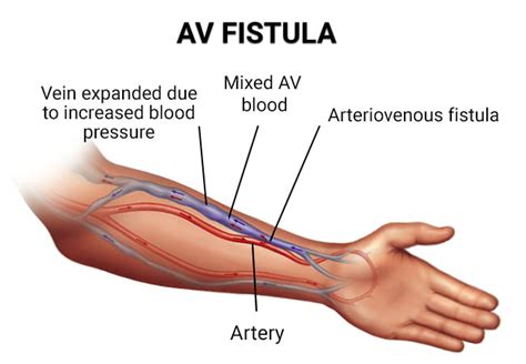 AV Fistula Creation in Brooklyn, NY & Bronx, NY - Vein & Endovascular Medical Care