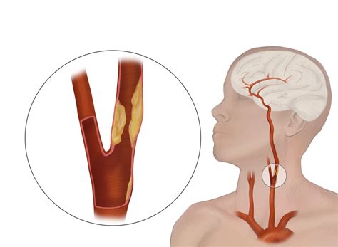 Diagnosi ecografica della stenosi dell'arteria carotidea - SONOSIF - di SIFSOF, California