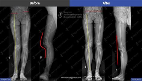 Genu Recurvatum – Limb Lengthening & Complex Reconstruction Service ...