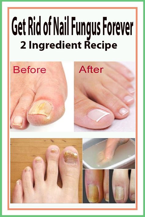 Get Rid of Nail Fungus Forever – 2 Ingredient Recipe | Toe fungus ...