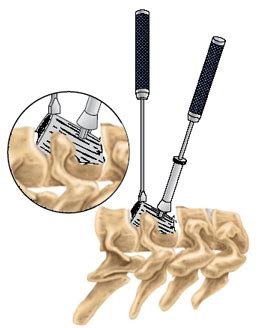 Anterior Cervical Corpectomy - Florida Spine & Orthopedics