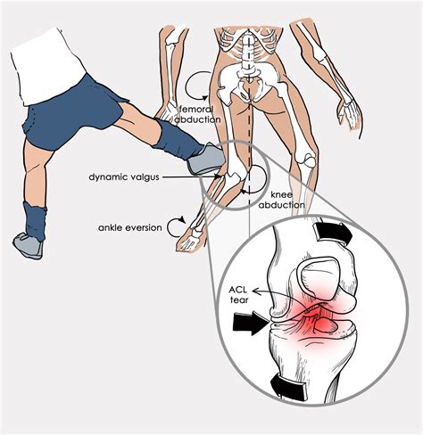 ACL Injury | PHYSIOCURE