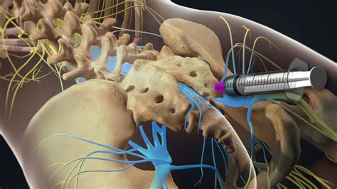 Orthopedic, Spine & SI Joint Injections for Pain - USA Spine Care