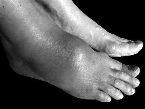A Rare Cause of Foot Swelling Mimicking Tenosynovitis | The Journal of ...
