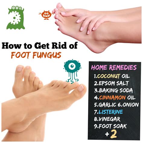 How to Get Rid of Foot Fungus #11 Athlete's Foot to Happy Feet