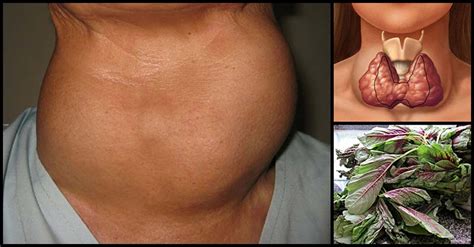 Common Remedies And Natural Ways That Can Help Shrink Goiter - Dr. Farrah MD