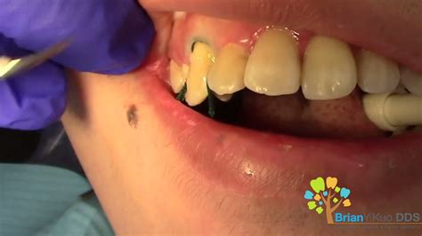 Cavity on Canine Tooth (Class 5 Facial Surface Filling) - Dental Clinic