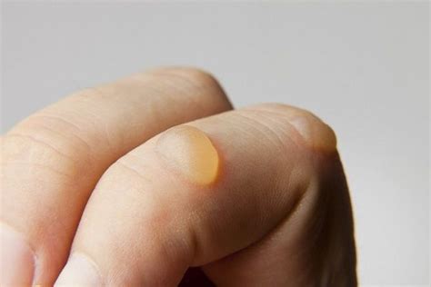 insect bites blister filled with clear fluid pop or not mosquito bites #mosquitobite, # ...