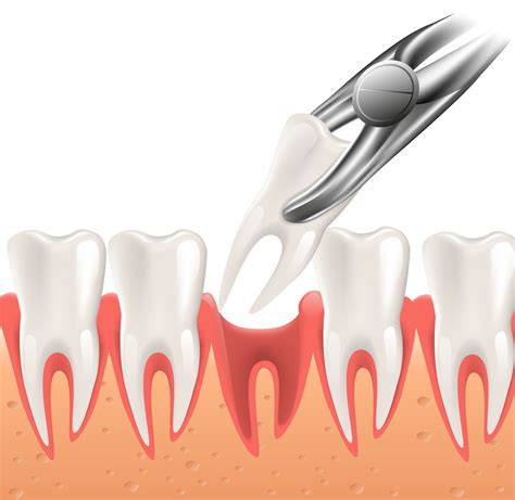 Tooth Extraction Home Care Instructions | Cobblestone Dental Care