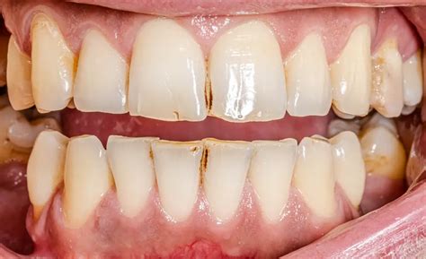 Can Rotten Front Teeth Be Fixed? (Everything You Need To Know)