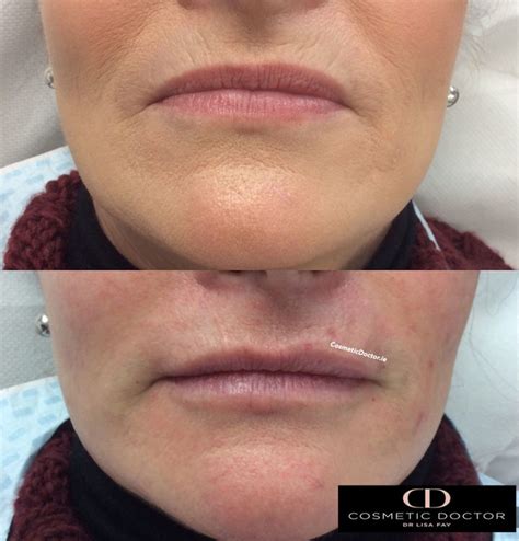 before after treatment for smokers lines - Cosmetic Doctor Dublin