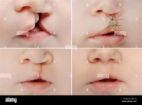 Cleft palate before after hi-res stock photography and images - Alamy