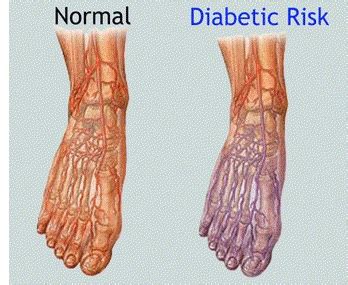 What Does Diabetic Nerve Pain In Feet Feel Like - DiabetesWalls