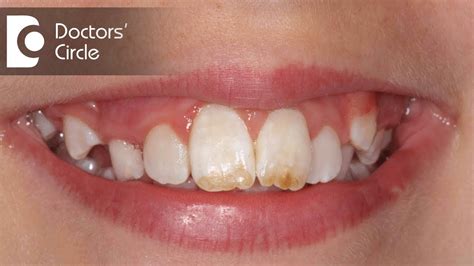 How do you treat Dental Fluorosis? - Dr. Aniruddha KB - Dental Clinic