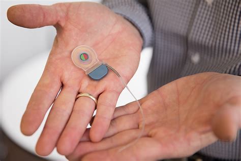 Interview With the Inventor of the MED-EL SYNCHRONY Cochlear Implant’s Rotatable Magnet - The ...