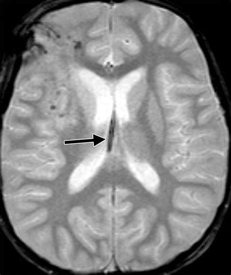 The Fornix in Health and Disease: An Imaging Review | RadioGraphics