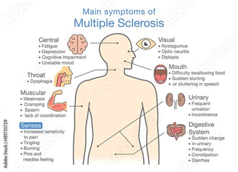 Main symptoms of Multiple Sclerosis. Illustration about medical diagram of health check up ...