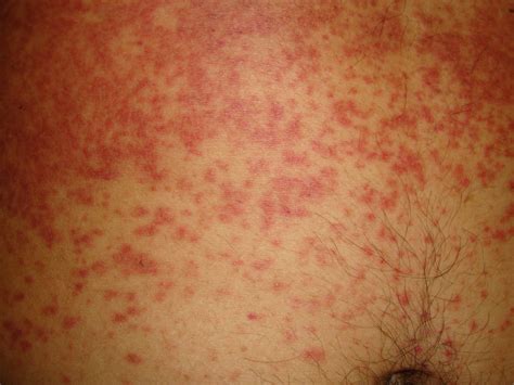 Urine Infection And Rash On Stomach at Richard Weaver blog