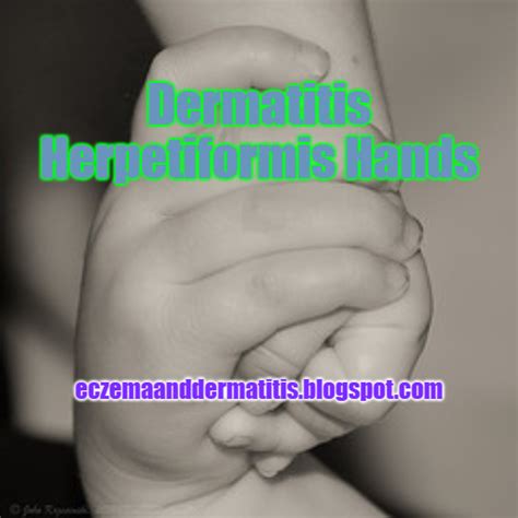 Dermatitis Herpetiformis Hands - Eczema and Dermatitis