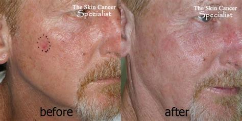 Laser Skin Cancer Therapy Treatment Surgery - Dr Peter Kim - Dr Peter Kim