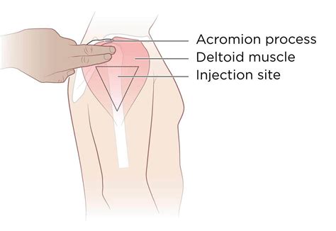 How To Do A Deltoid Injection For TRT - Full Guide + Demo - The TRT Hub